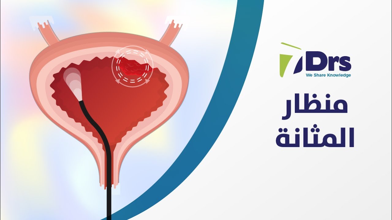 منظار المثانة