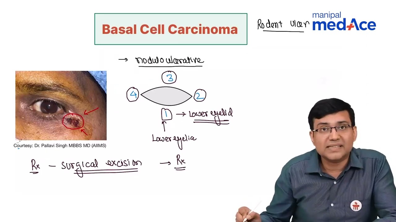 Understanding Eyelid Tumors: Insights by Dr. Vineet Sehgal | Manipal MedAce
