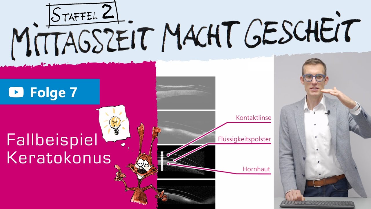 Kontaktlinsenversorgung bei Keratokonus – Ein Fall von S. Jäkel (Mittagszeit macht gescheit – S2 F7)