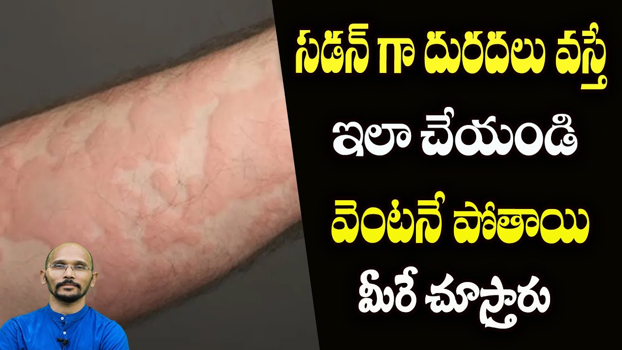 సడన్ గా దురదలు వస్తే ఇలా చేయండి వెంటనే పోతాయి | Urticaria | Dr.Madhu Babu Health Trends