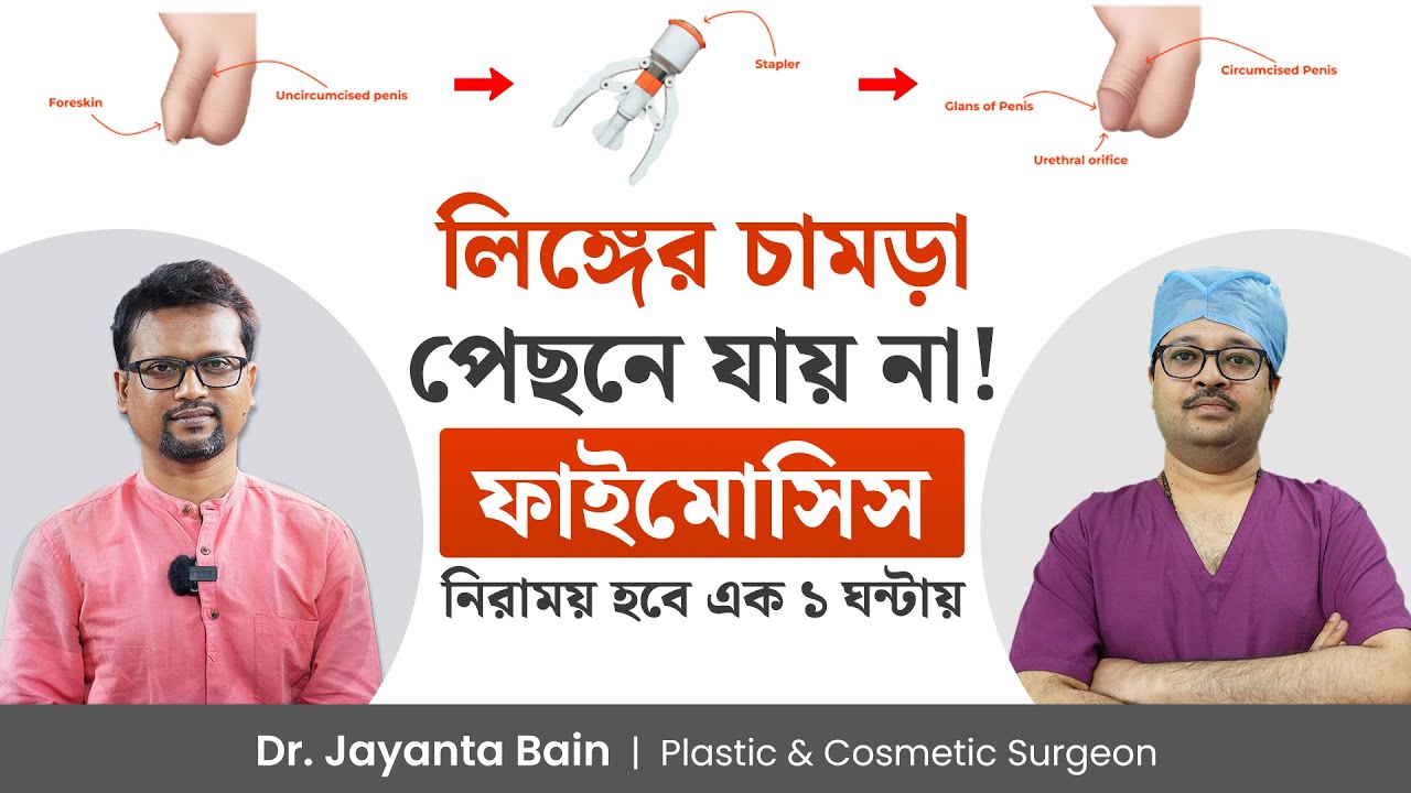 লিঙ্গের চামড়া পেছনে না গেলে কি করণীয়? ফাইমোসিসের চিকিৎসা কিভাবে করা হয় এর খরচ কত? Dr. Jayanta Bain
