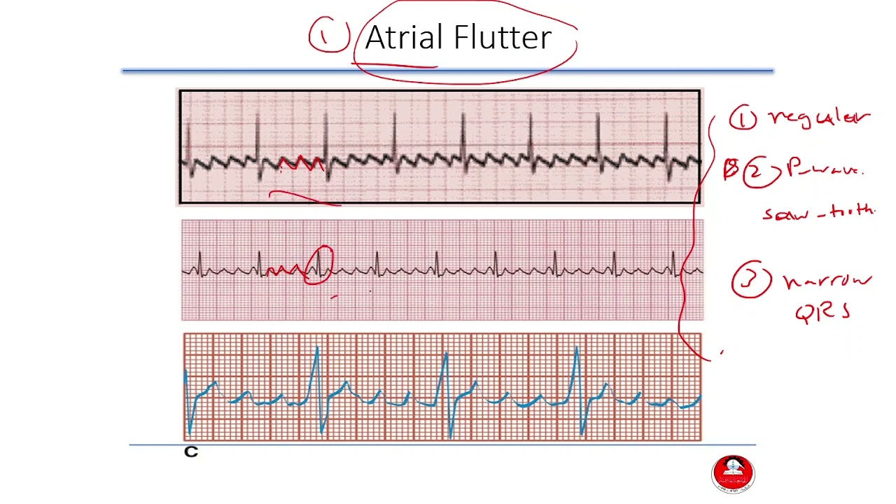 Interpreting an Electrocardiogram (ECG) in a Nutshell