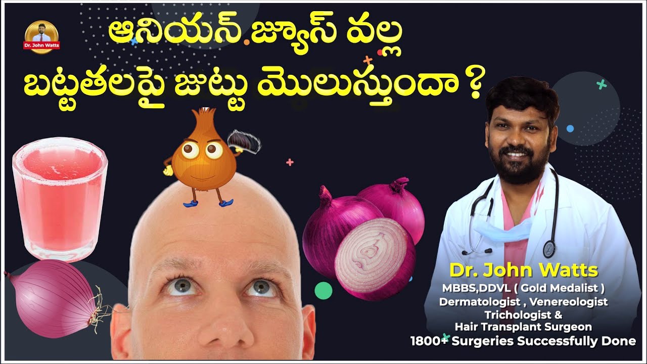 ఆనియన్ జ్యూస్ వల్ల బట్టతలపై జుట్టు మొలుస్తుందా? | Does Onion Juice increase Hair on Bald Head?