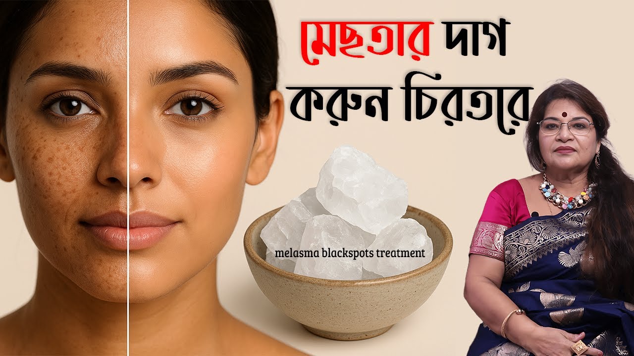 ফিটকীরি এইভাবে মাখলে পুরোনো মেছতার দাগ দূর হয়ে যাবে নিমিষে  - Reduce melasma blackspots treatment