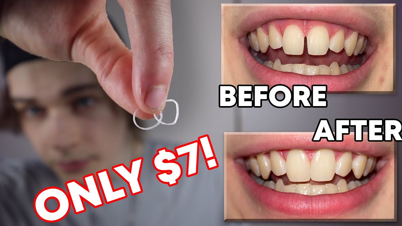 How I Closed The Gap In My Teeth In LESS THAN 1 WEEK!? (DIY Budget Braces / Gap Bands)