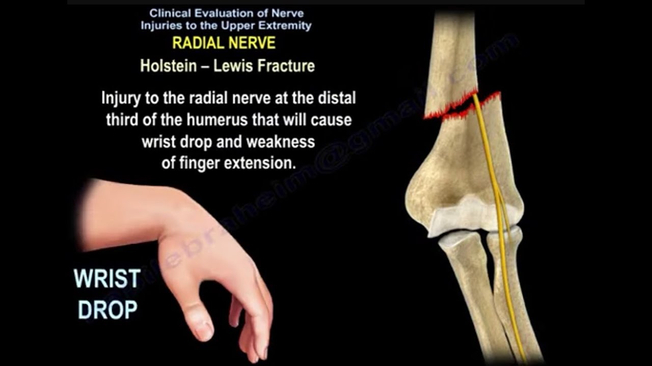 Upper Extremity Nerve Injuries: Diagnosis, Motor & Sensory Testing Simplified