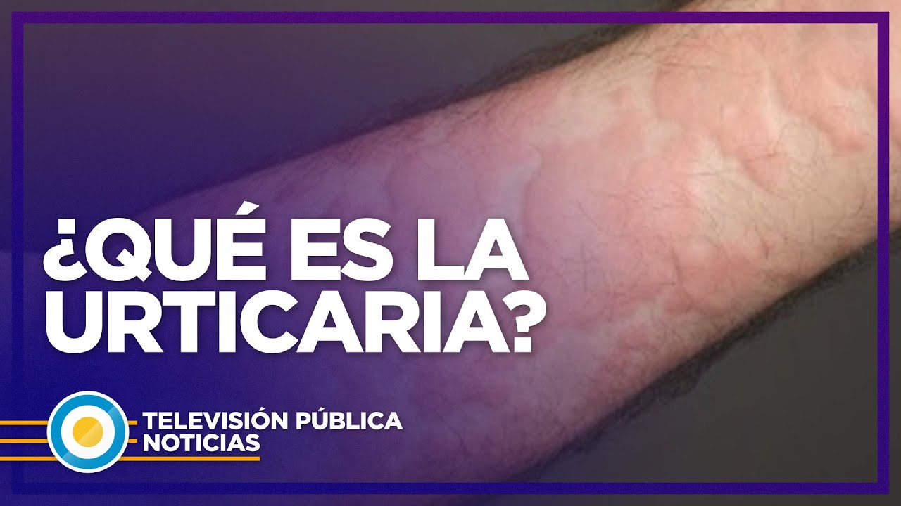 Qu&eacute; es y c&oacute;mo tratar la urticaria