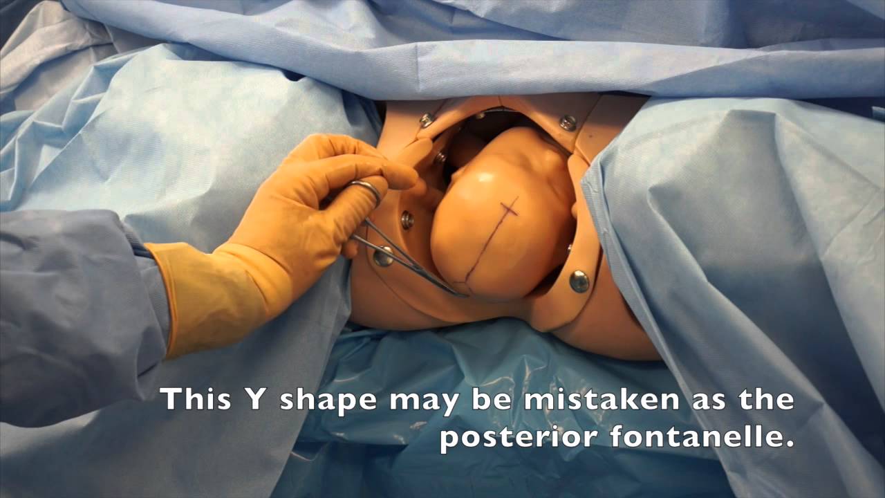 Scanzoni Maneuver to Deliver ROP with Asynclitism