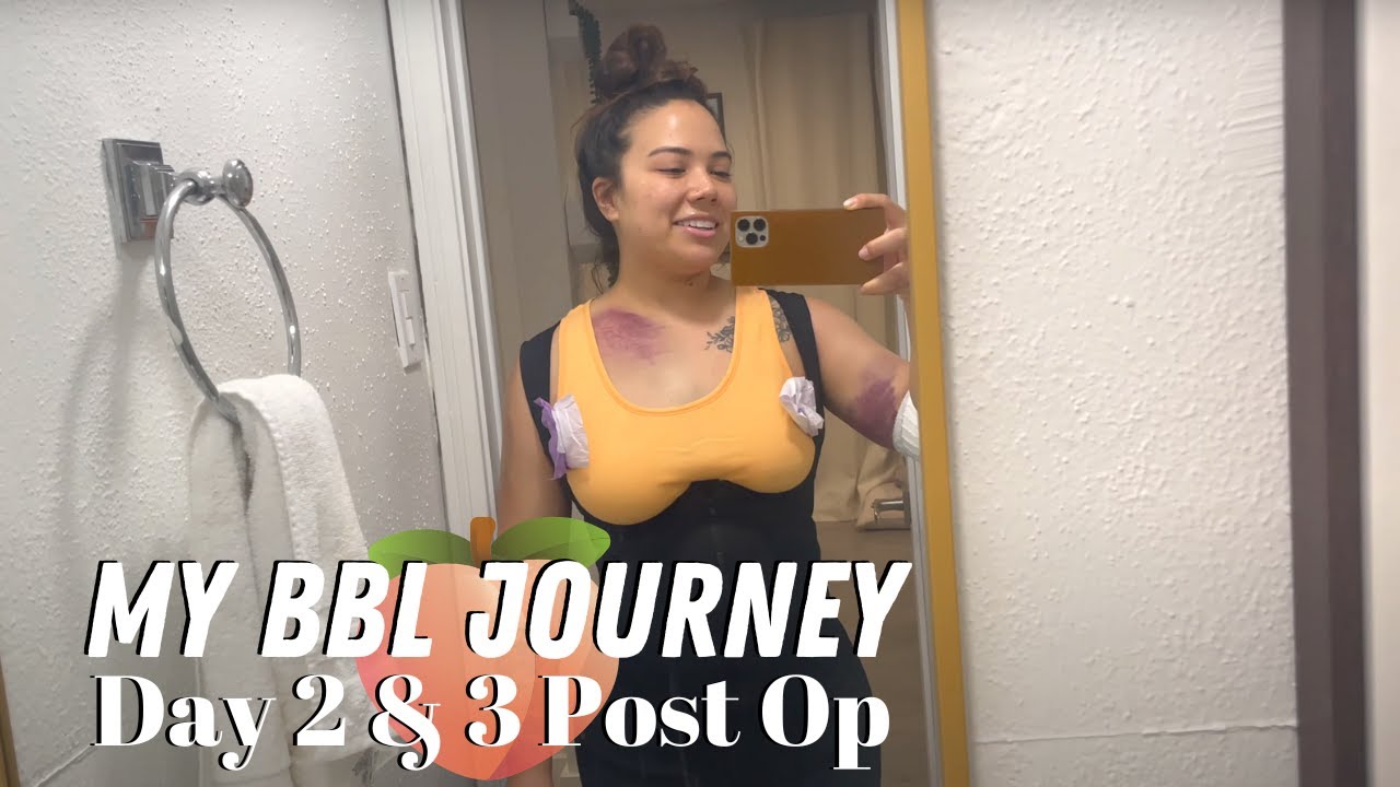 MY BBL SURGERY WITH DR. JUNG MONEY | MY BBL JOURNEY | DAY 2 & 3 POST OP | KRISTEN MARIE