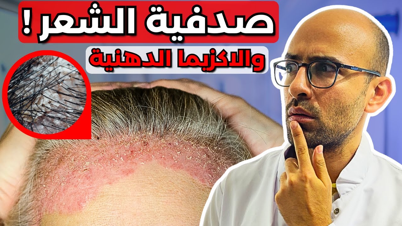 عشر نصائح ذهبية للشعر المصاب بالصدفية (و الاكزيما الدهنية ) - لمنع تساقط الشعر !