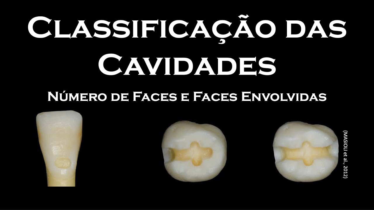 Classificação das Cavidades pelas Faces Envolvidas | Dentística