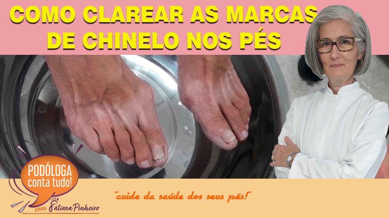 COMO CLAREAR MARCAS DE CHINELO NOS PÉS