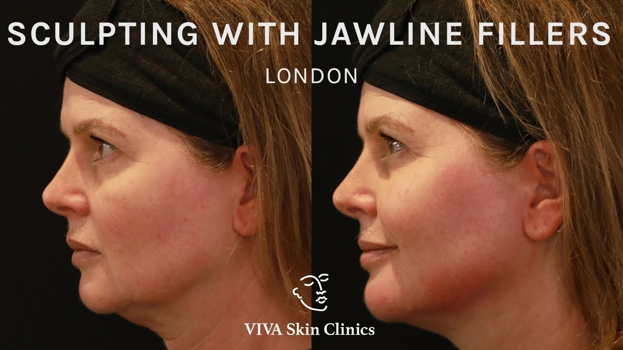Sculpting with Jawline Fillers | VIVA Skin Clinics London
