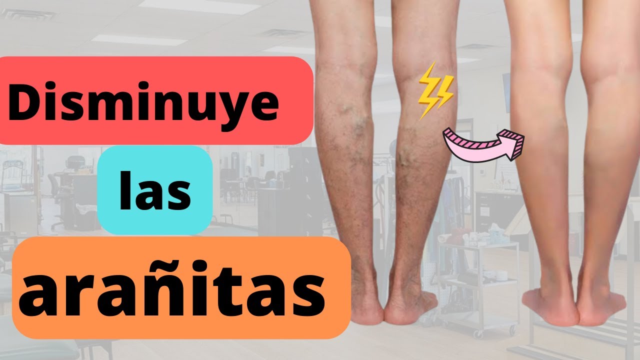 Disminuye las arañitas de tus piernas haciendo ejercicio antes de dormir