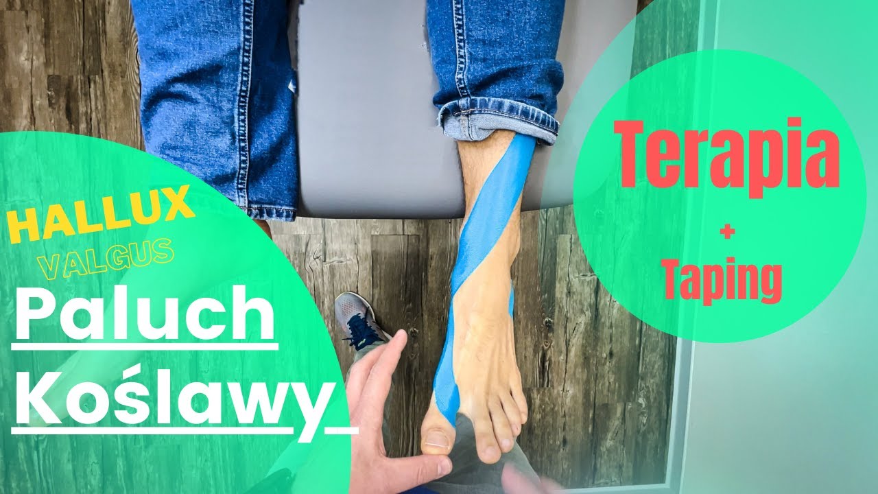 Paluch Koślawy (Hallux Valgus) - Terapia i taping #177 FizjoTerapia HD
