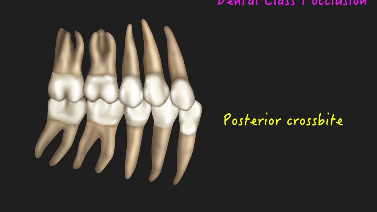 Clinical Tip: Use Bite Turbos in the Correction of Posterior Crossbite｜【Chris Chang Ortho】CC431
