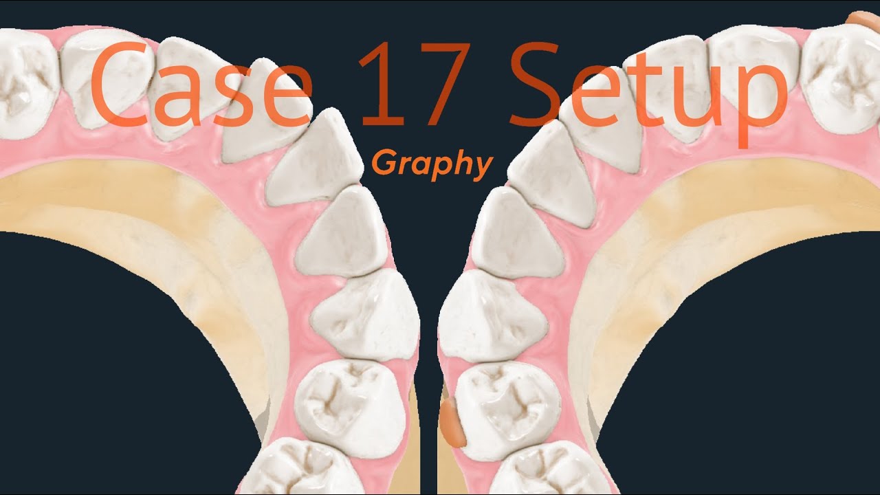 Maestro 3D aligners virtual setup: case 17, Graphy direct aligners