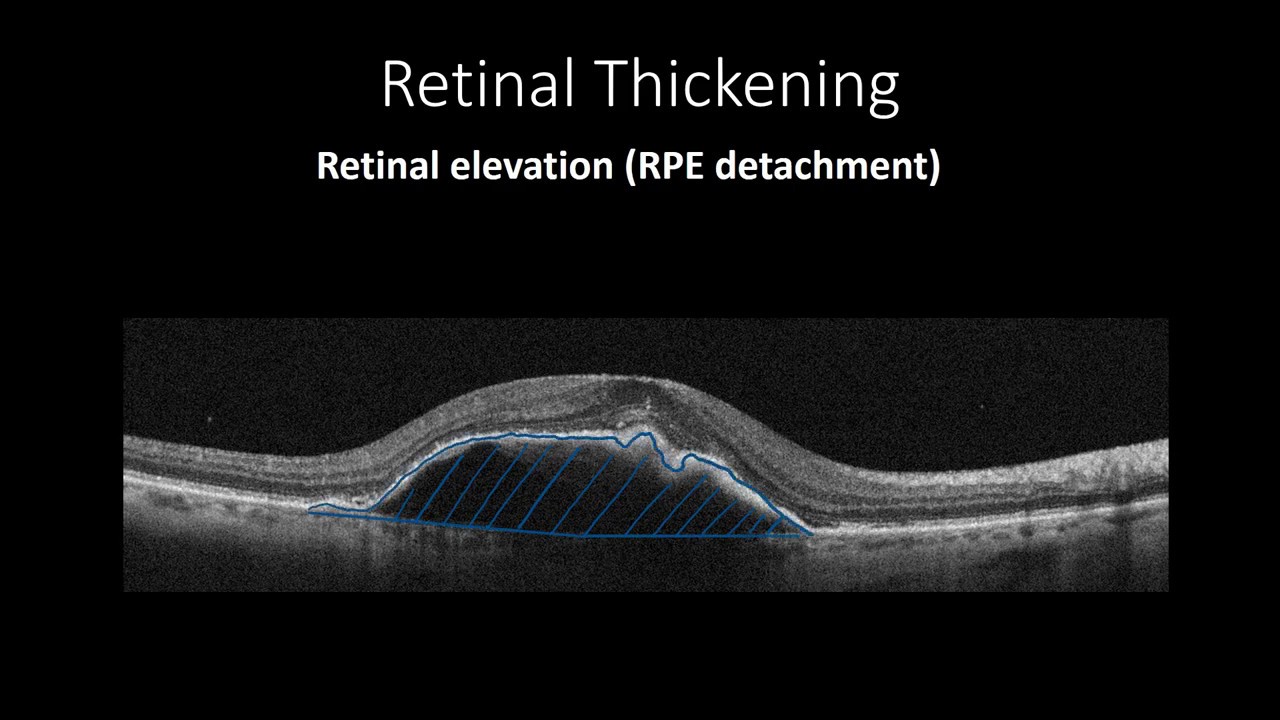 Course in clinical applications of OCT for macular diseases -Pathological changes in OCT part one