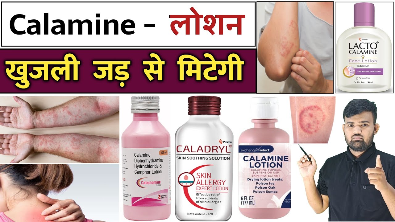 खुजली का इलाज | Calamine Lotion | Antifungal Cream | Treatment | Medicine | Pharmacy | Infection