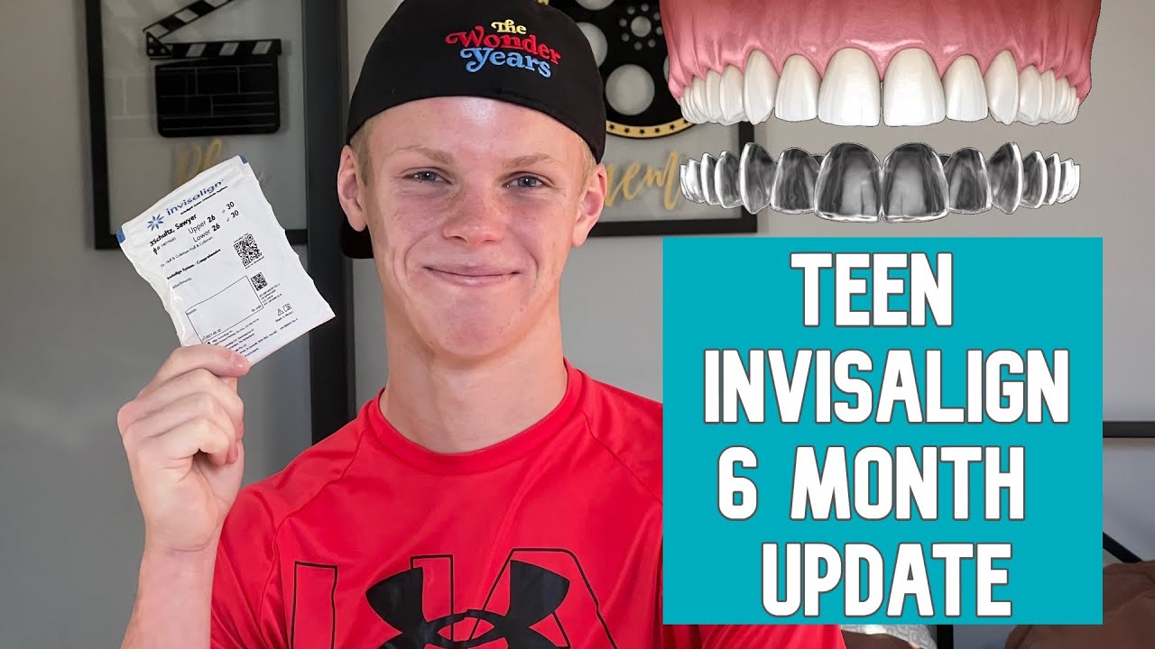 Teen Invisalign 6 MONTH UPDATE - Invisalign vs Braces