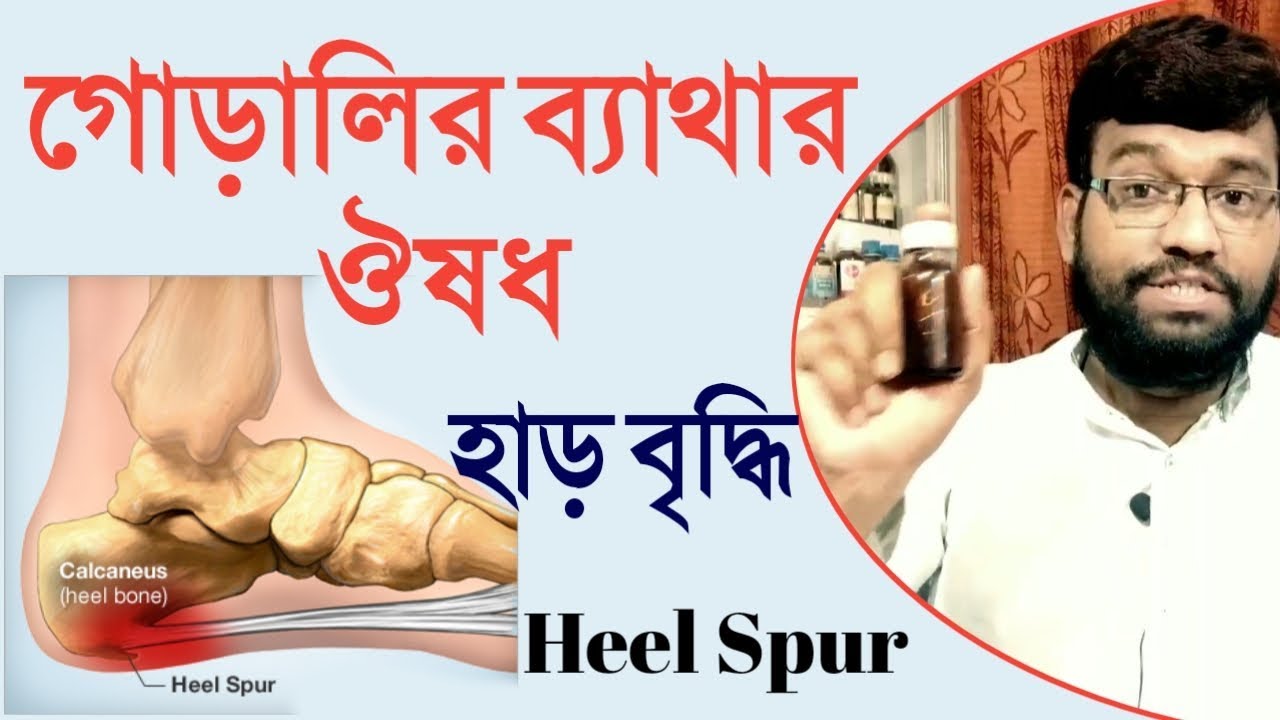 গোড়ালির ব্যাথা হাড় বেড়ে যাওয়া দূর করার হোমিওপ্যাথি ঔষধ | heel pain spur calcaneal spur homeopathic