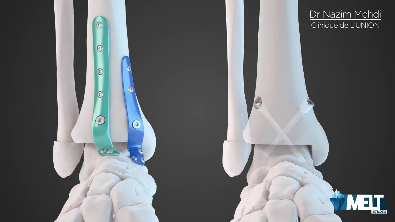 Arthroplastie Cheville avec Plaques et Vis
