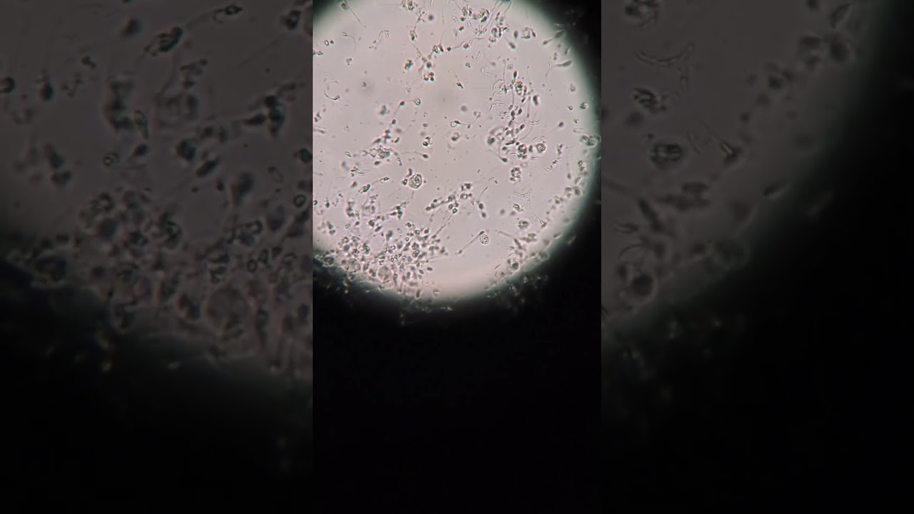 Sperm agglutination, observed under a microscope 🔬#sperm #spermatogenesis