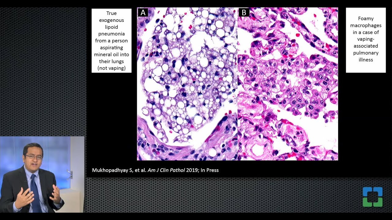Pathology of Vaping-Associated Lung Injury with Sanjay Mukhopadhyay, MD