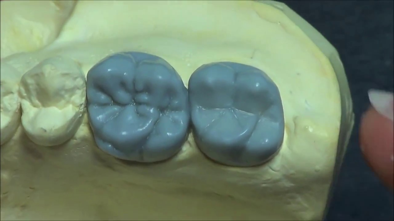 Live wax up - Upper 2nd molar(occlusion)