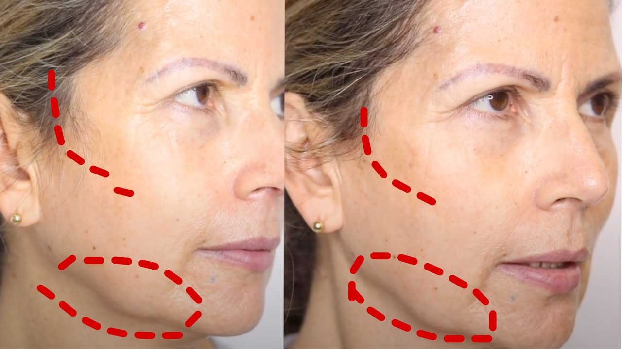 HIFU FACIAL ANTES Y DESPUES 😱😱 | MÁS JOVEN CON HIFU  👋🏼😱