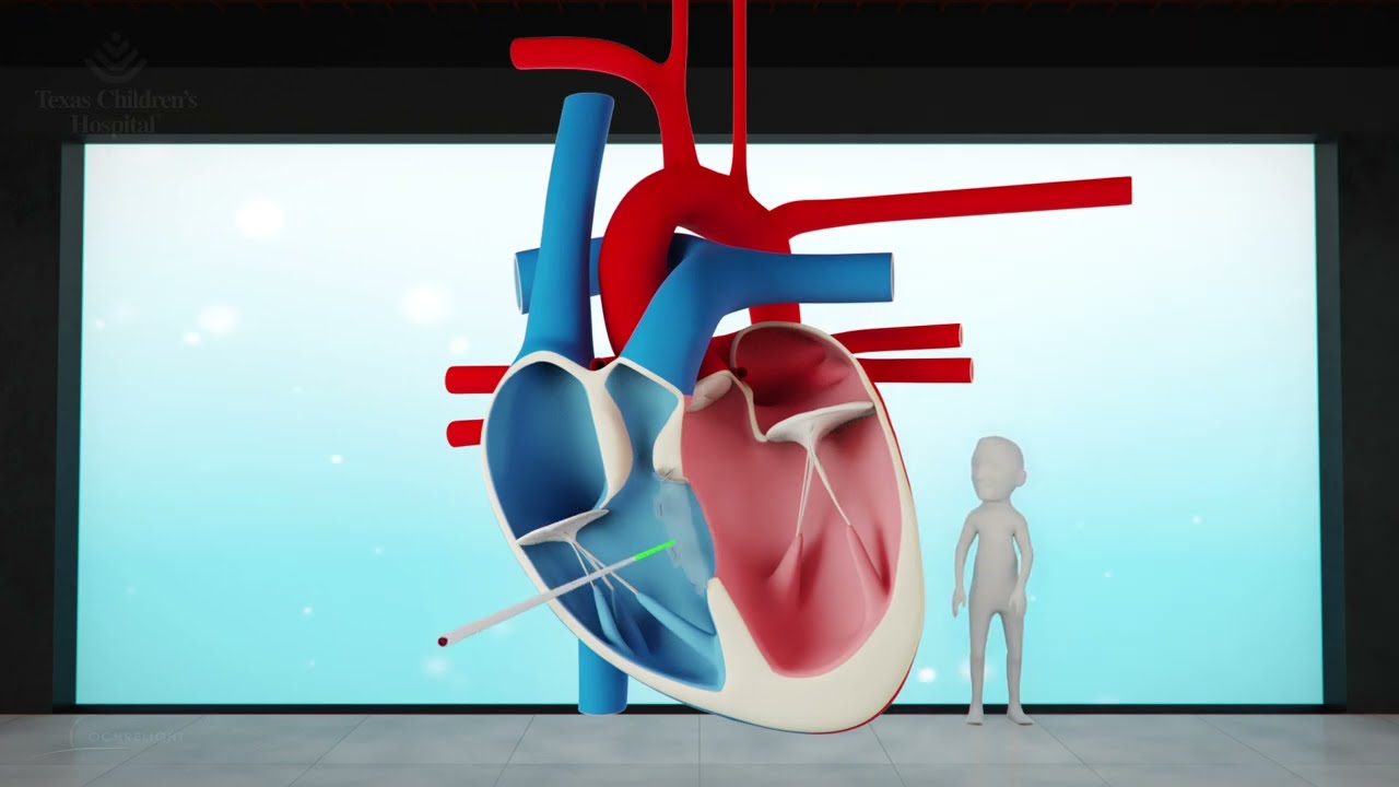 Ventricular Septal Defect (VSD)