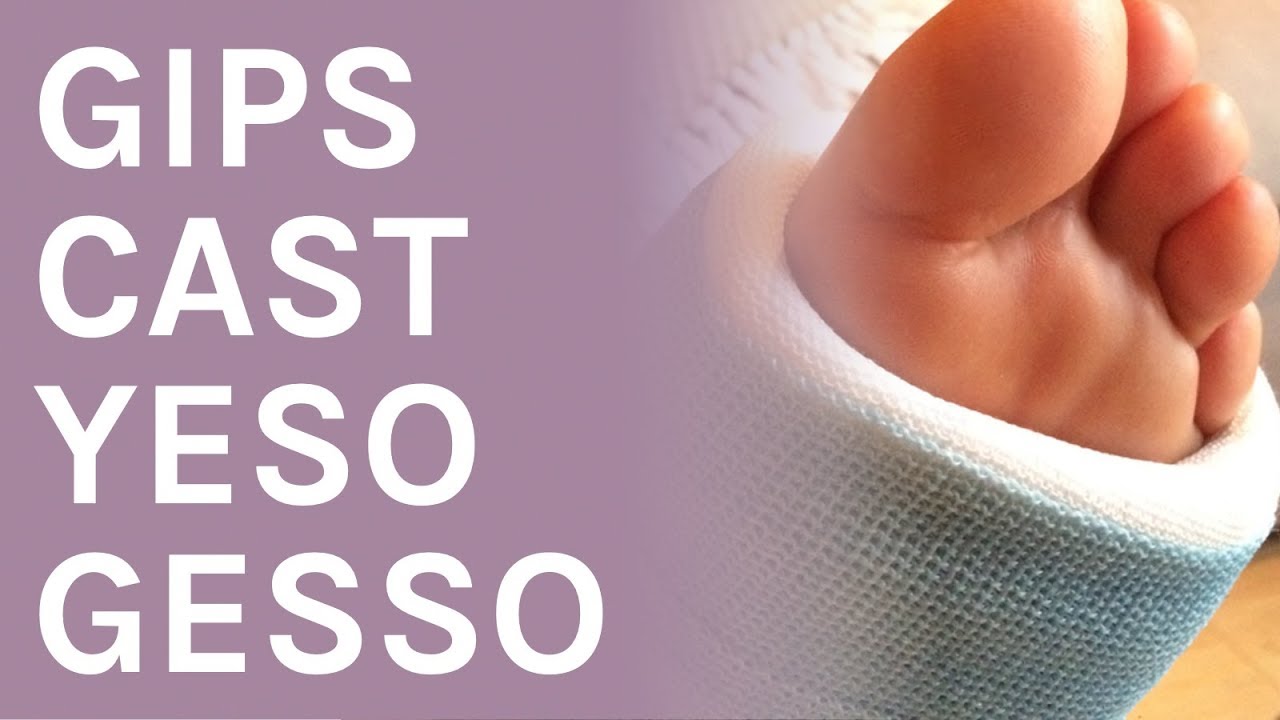 Gipsbein | leg cast | gesso piede | yeso pie