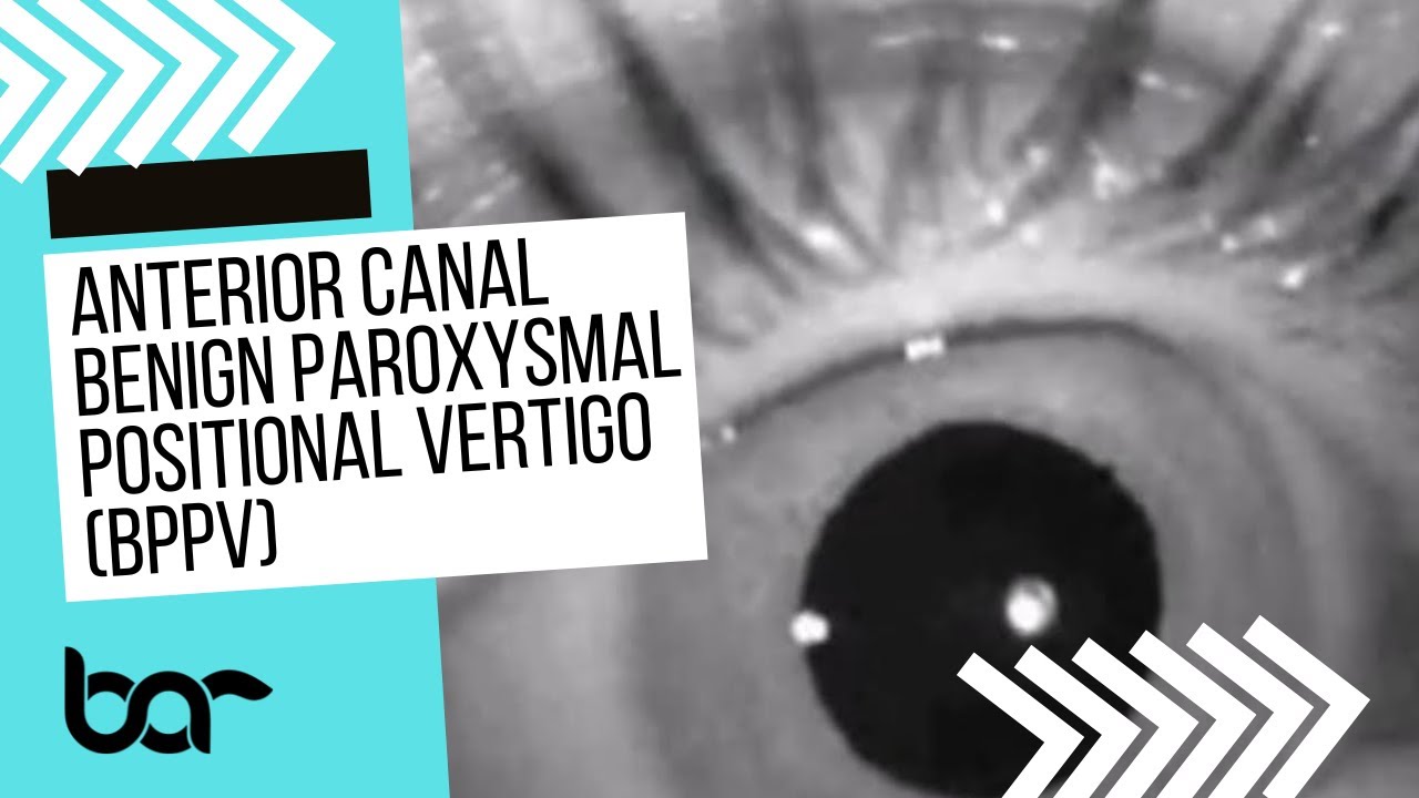 Anterior Canal BPPV Nystagmus