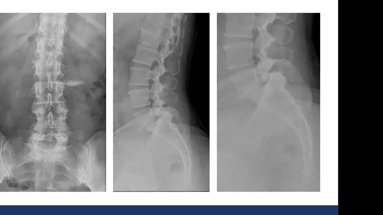 Canal lumbar estrecho