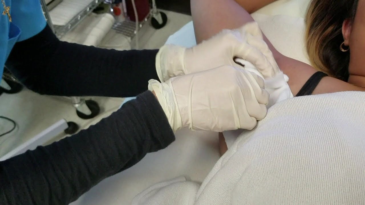 miraDry procedure removes underarm sweat and odor for good