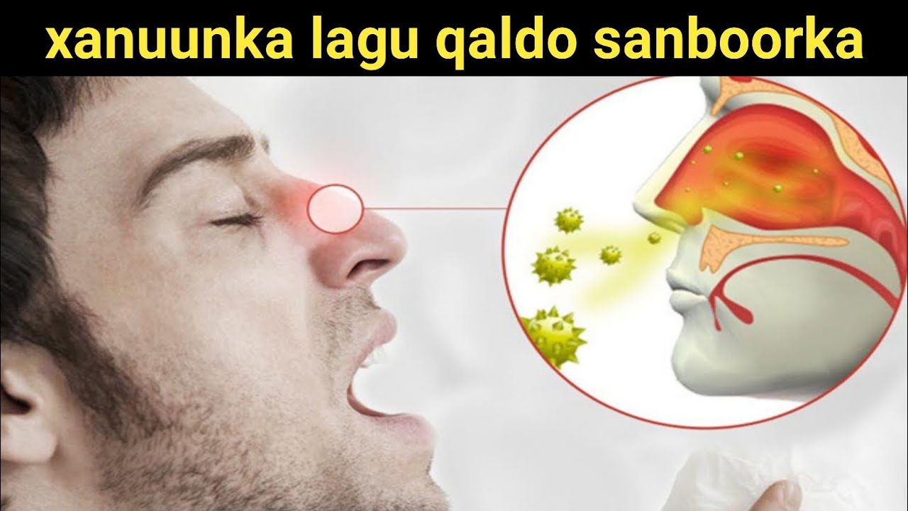 caabuqa ku dhaca sanqada ee lagu qaldo sanboorka
#xanuunka