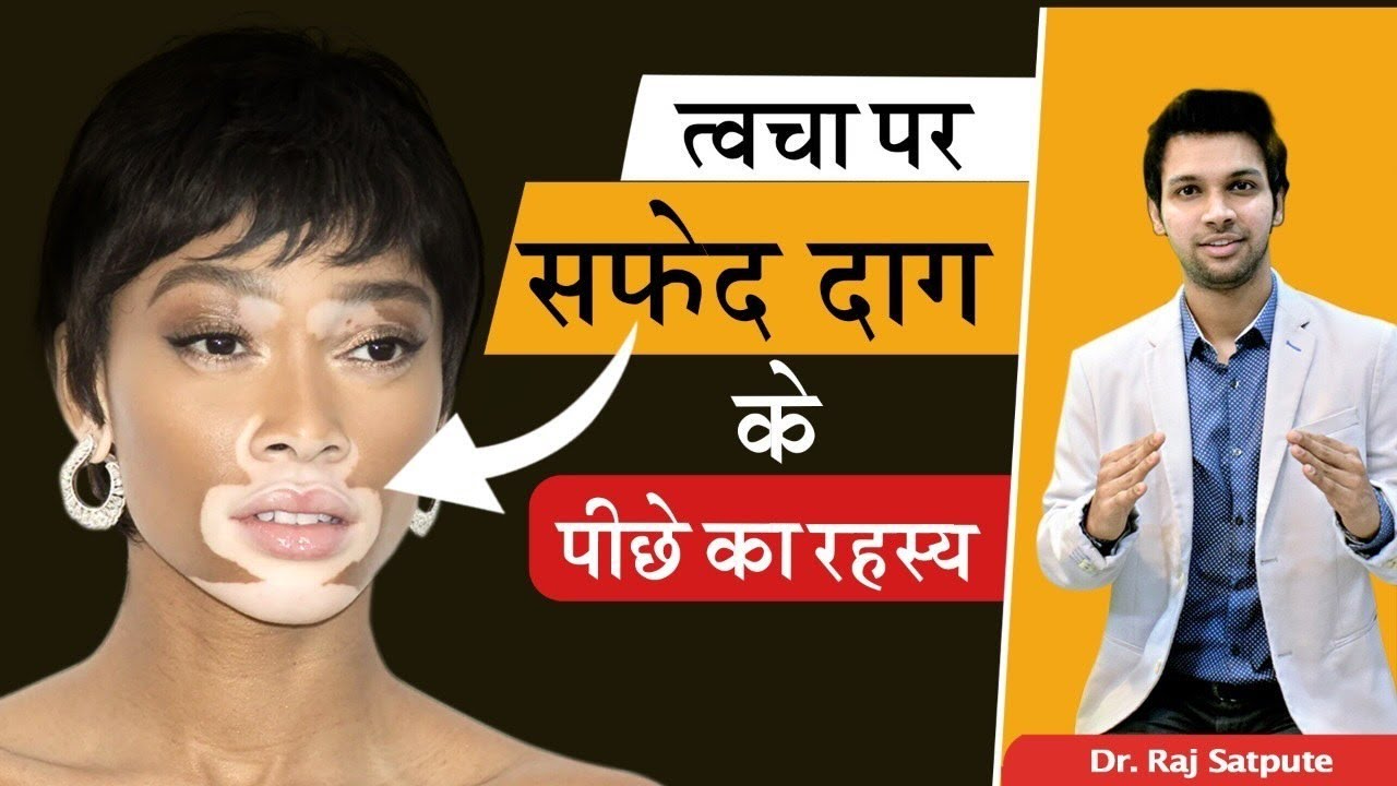 Vitiligo (Leucoderma) का कारण क्या है ? सफ़ेद दाग के पीछे का रहस्य | White Patches on Skin in HINDI