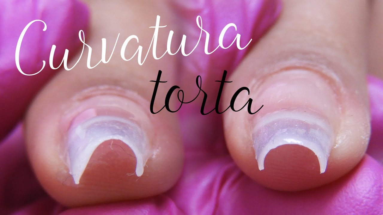 Curvatura Torta? Saiba O Que Fazer Para Isso Não Acontecer