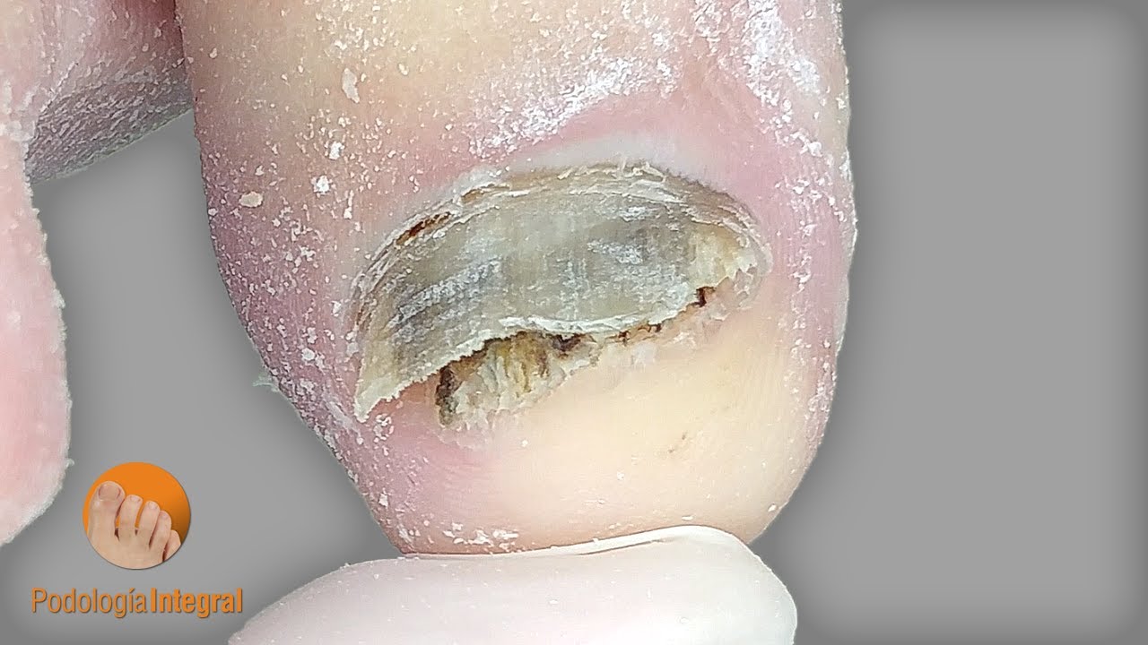 Fungal nails | Podolog&iacute;a Integral