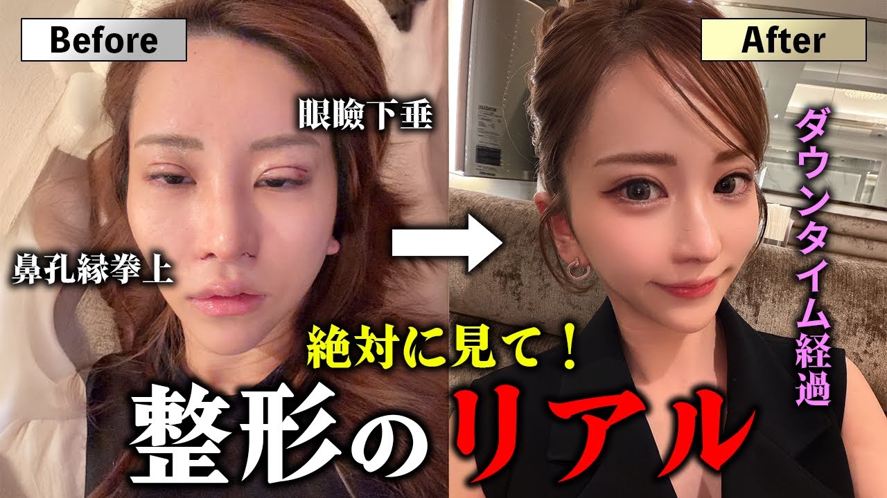 【私の秘密】美容整形のダウンタイムリアル経過を見せます。