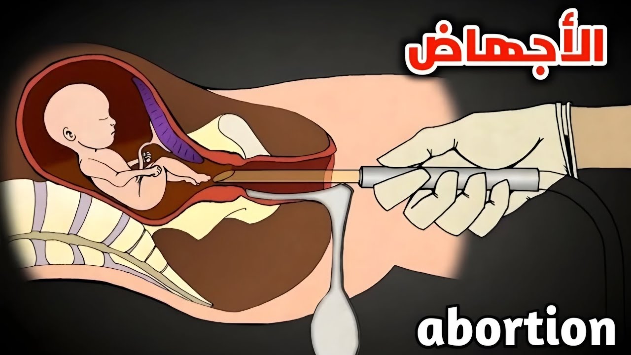 كيف تتم عملية الإجهاض؟ تعرف على الطرق الطبية والجراحية لإنهاء الحمل بأمان | هل تعلم هذا؟