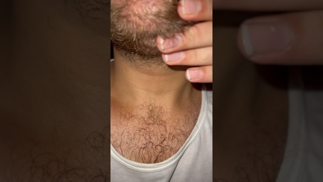 #ingrownhair