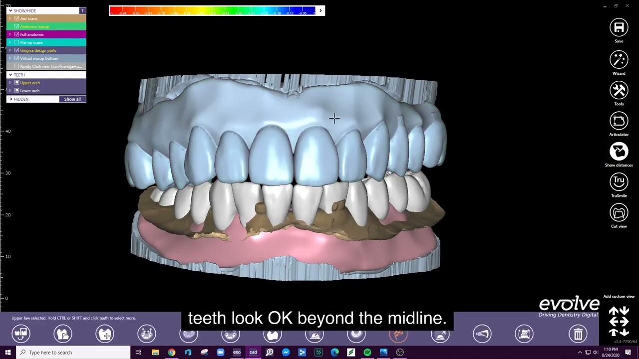 Digital Remounting In Exocad
