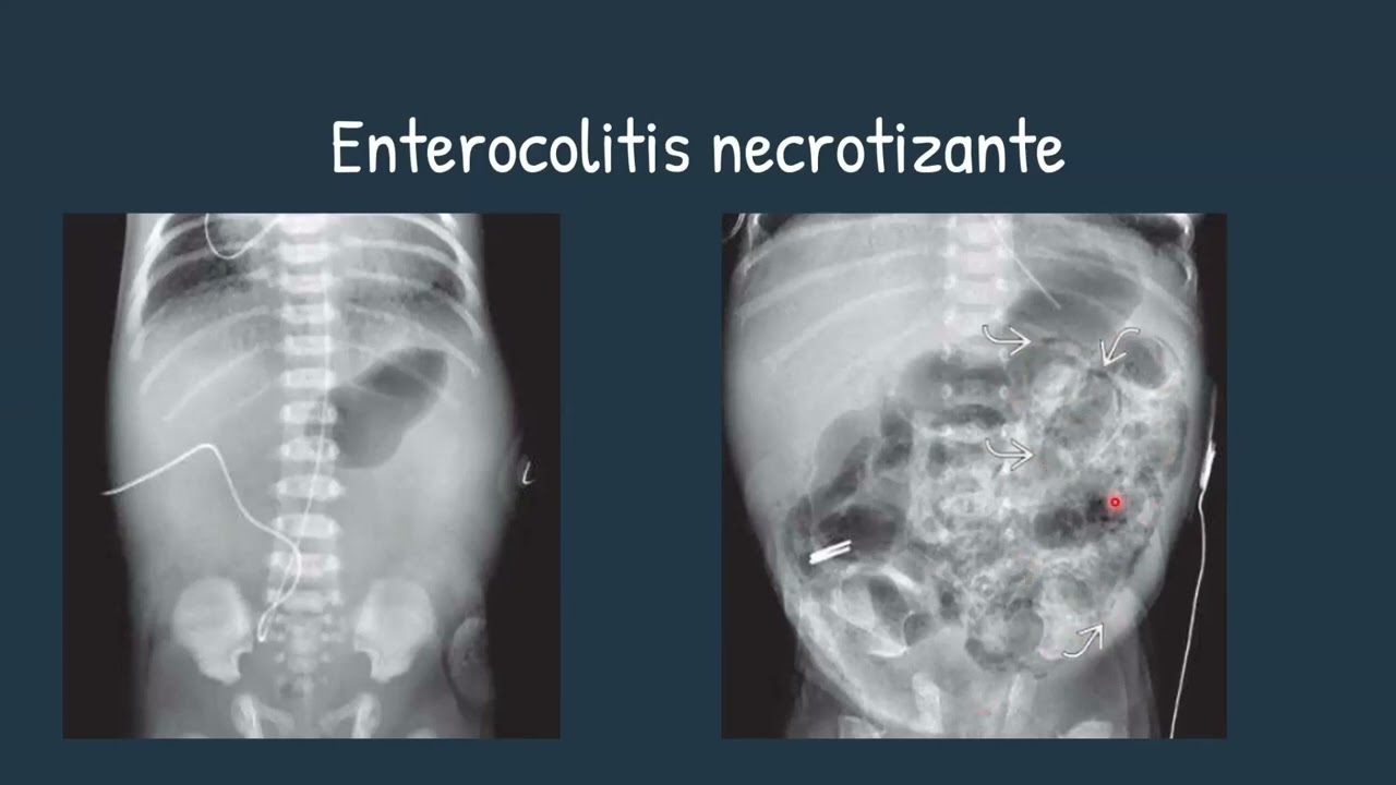 Pediatr&iacute;a. Secci&oacute;n 4: Gastrointestinal. Dra. M&oacute;nica Olivas