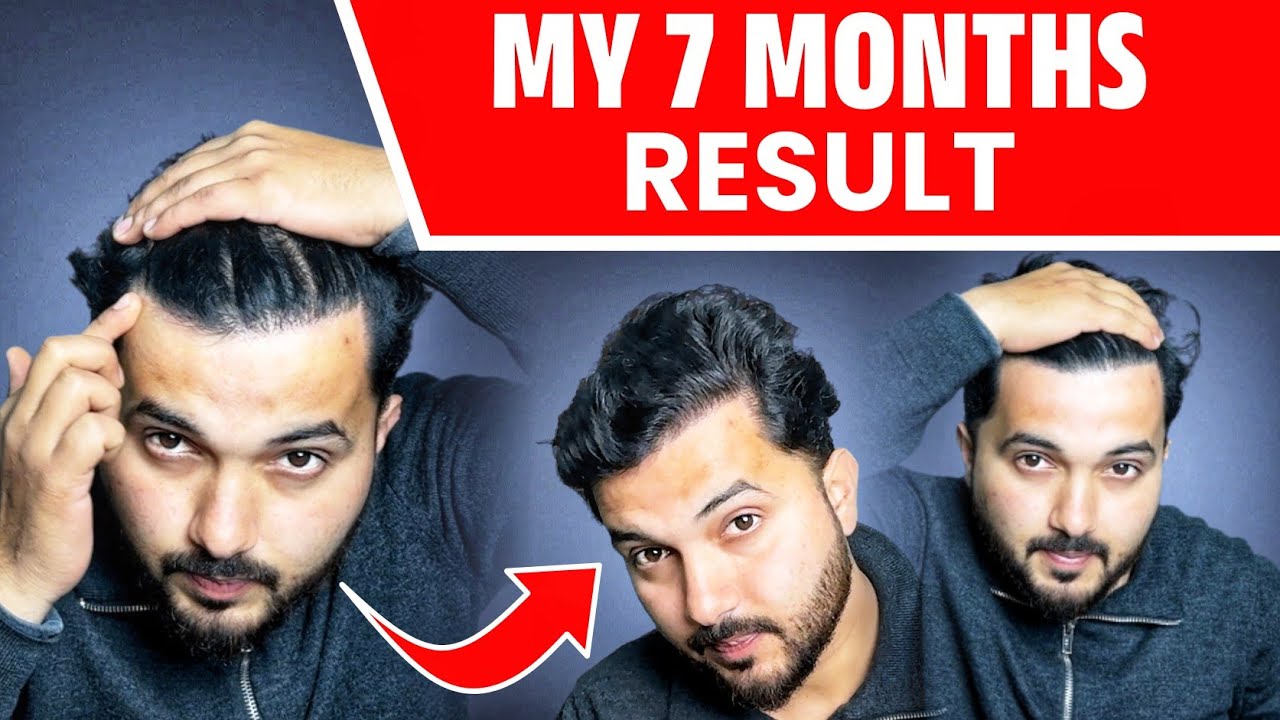 Hair Transplant Result After 7 And Half Months 🔥