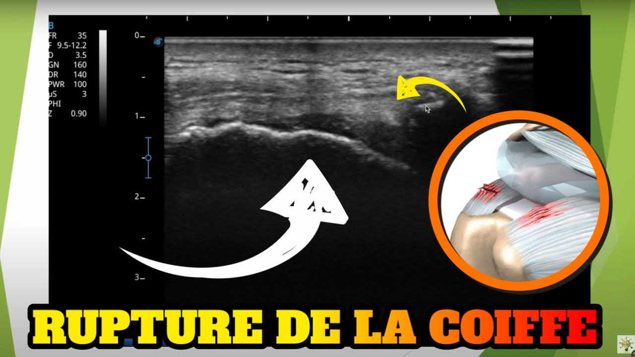 Echographie d'une rupture de la coiffe des rotateurs