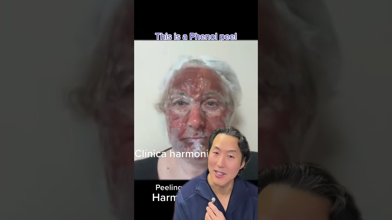INCREDIBLE Chemical Peel Transformation! #shorts #chemicalpeel