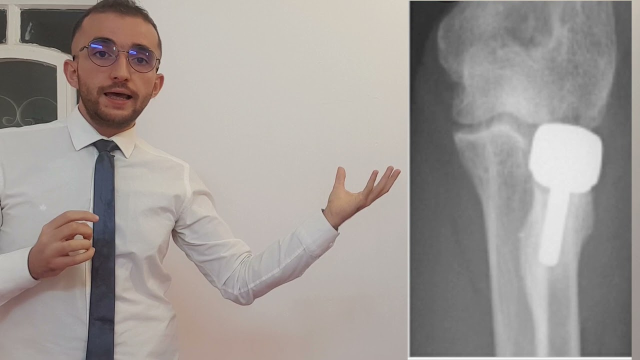 UL: Radial head fracture l كسر راس الكعبرة (انظر للوصف)