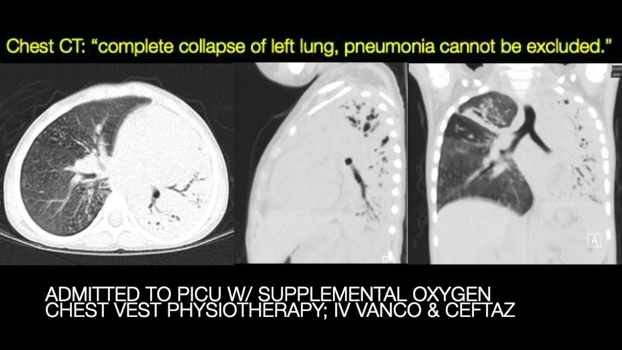 Atelectasis Case 2: 5 year old with Cystic Fibrosis