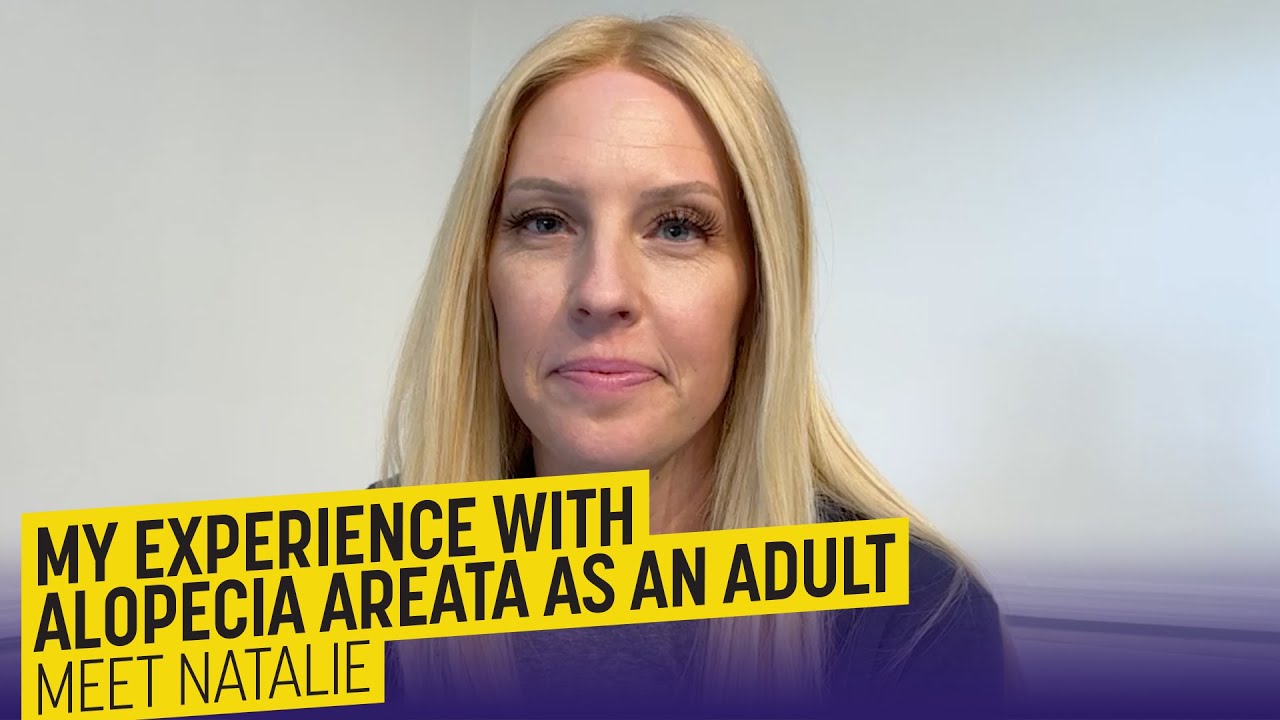 My experience with alopecia areata as an adult